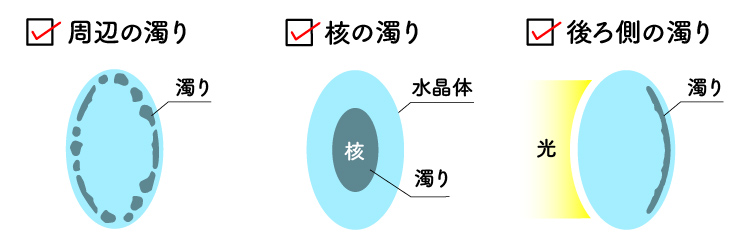 白内障による水晶体レンズの濁り